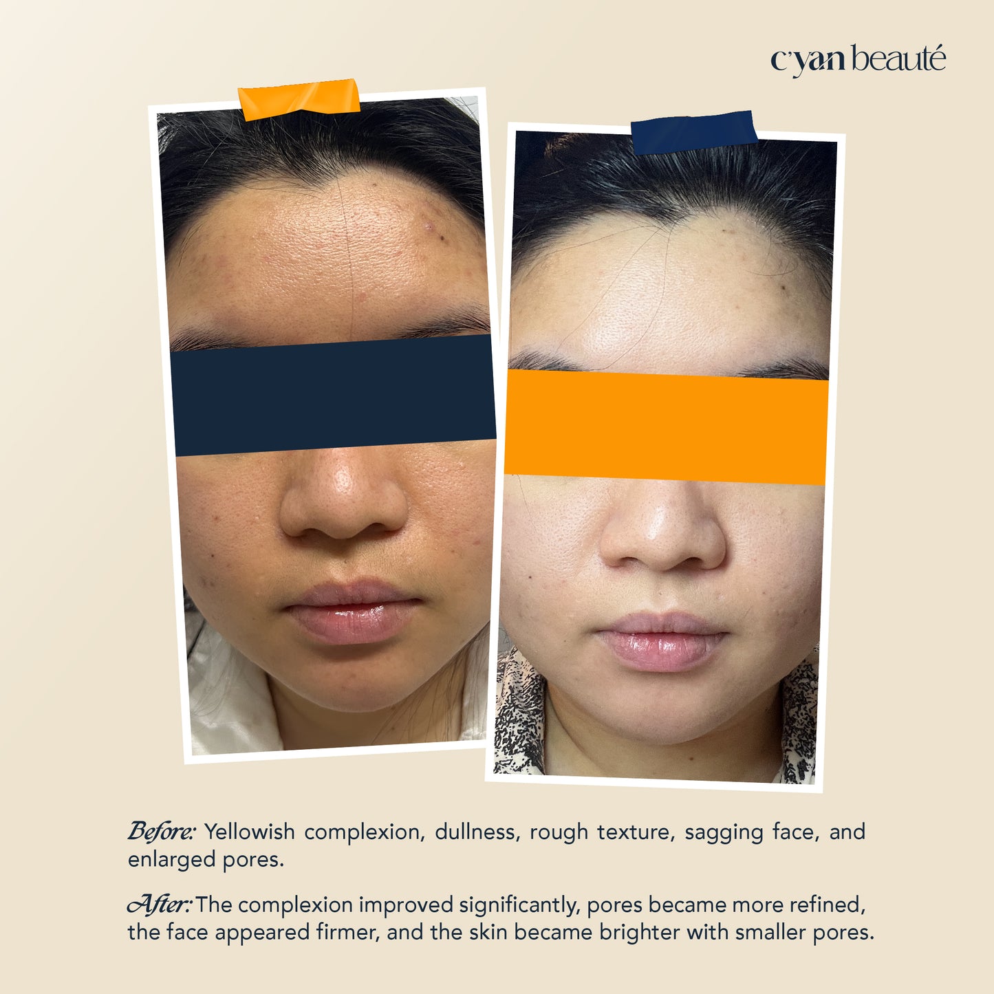 Fermented Tremella Moisturizing Treatment Mask